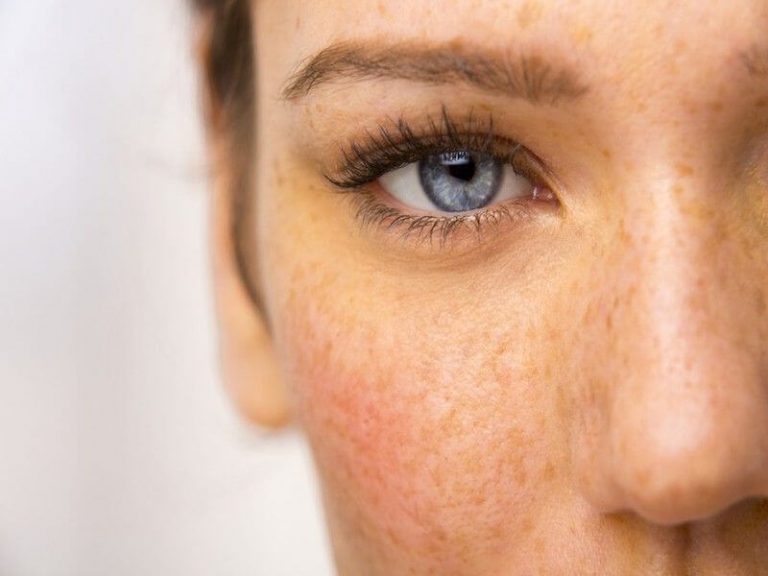 Beneficios del tratamiento facial despigmentante Physio Wellness & Beauty