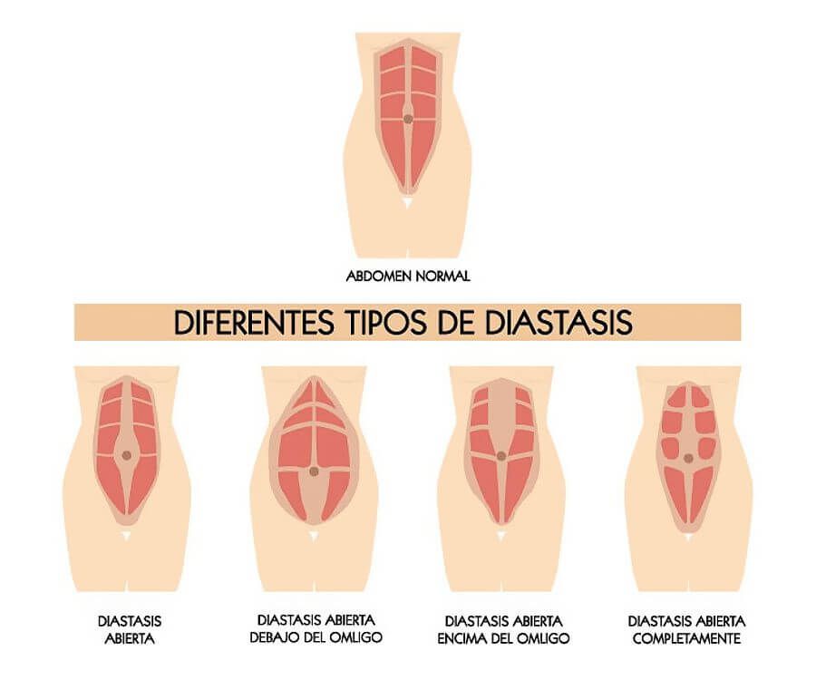 Diástasis abdominal y beneficios de fisioterapia dermatofuncional en el postparto